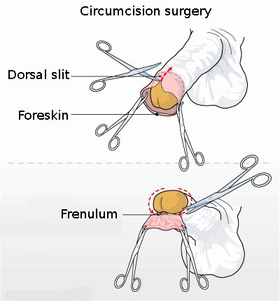 Line drawing diagram of circumcision with hemostats and scis