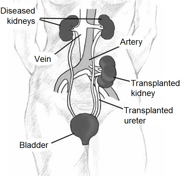 Kidney location after transplantation adapted from the origi