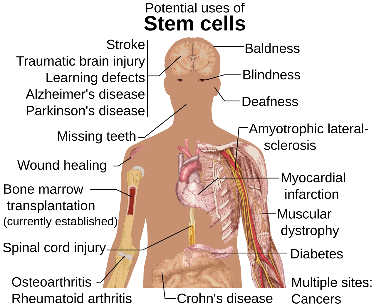 Diseases and conditions where stem cell treatment is promisi