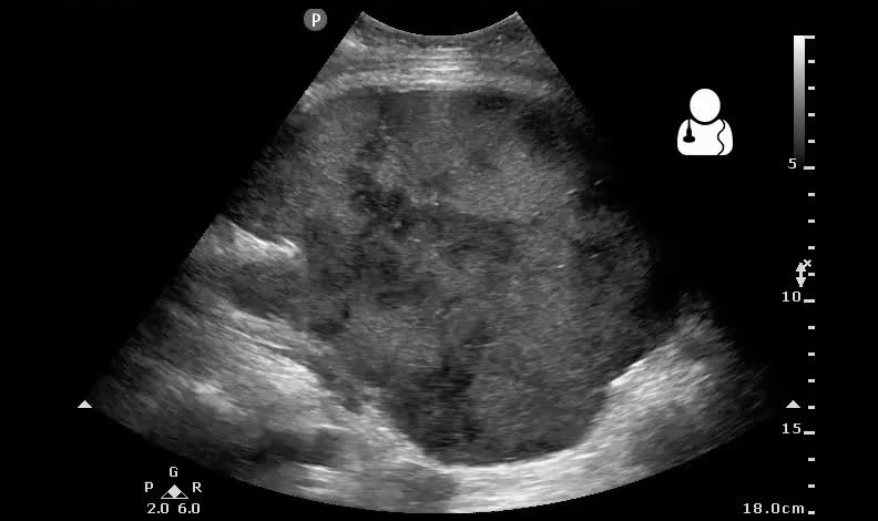 The patient is a 39 y o female with a h o lupus who is post