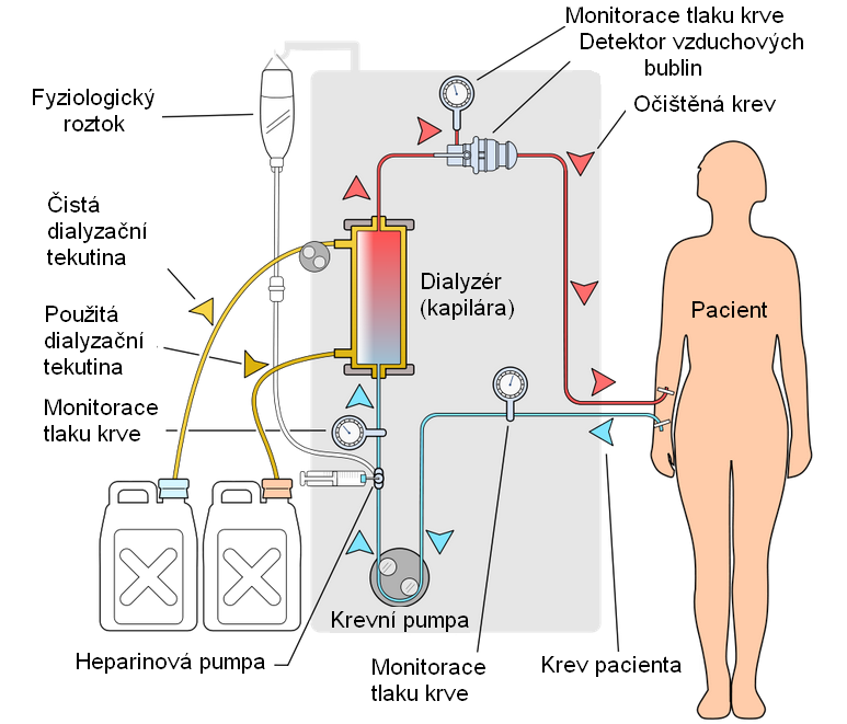 Simplified hemodialysis circuit
