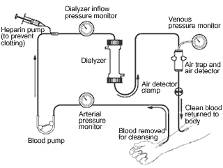Schematic of a hemodialysis circuit
