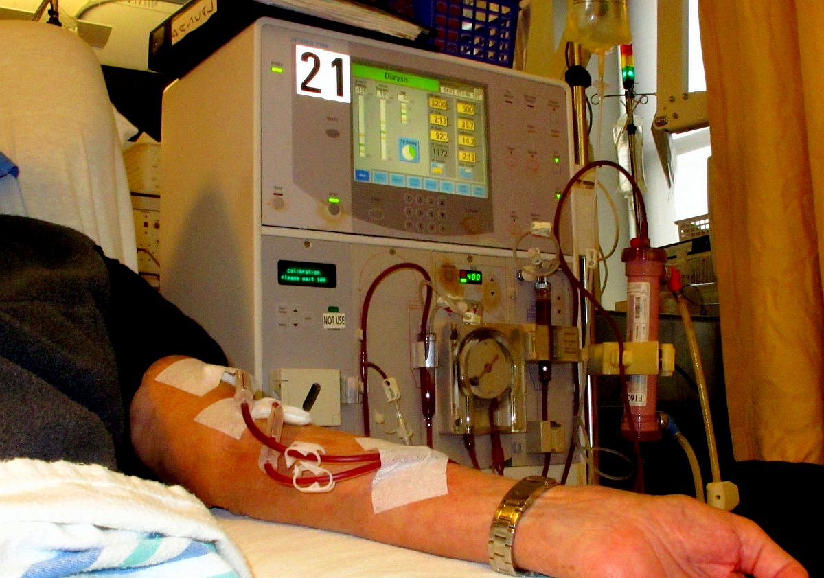 Arm of patient receiving dialysis