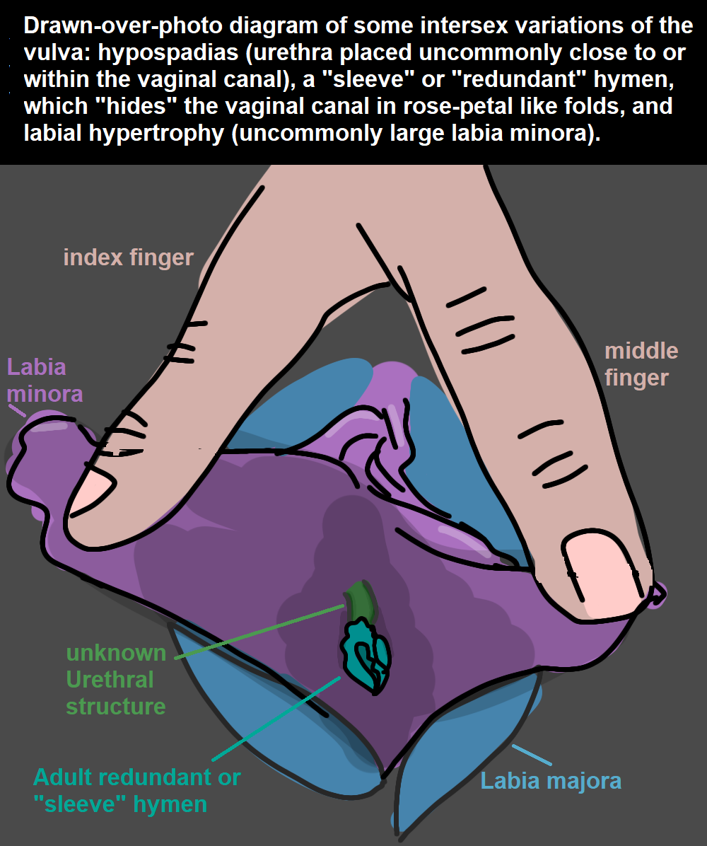 A color coded diagram drawn over a photo showing vulvar hypo