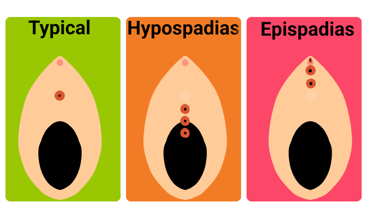 A diagram of hypospadias and epispadias as may be seen in a