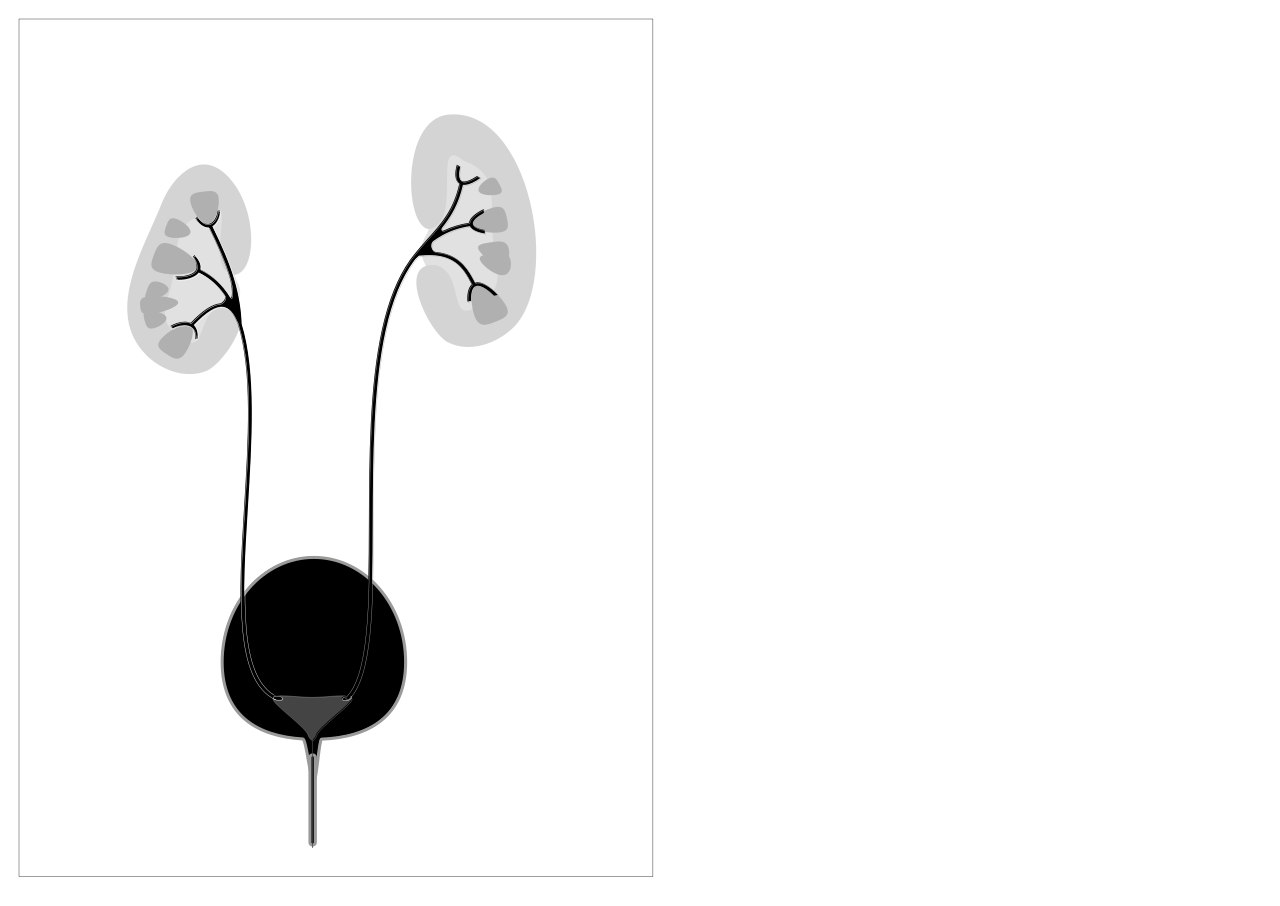 Grades 1 vesico ureteric reflux shown on right of the diagra
