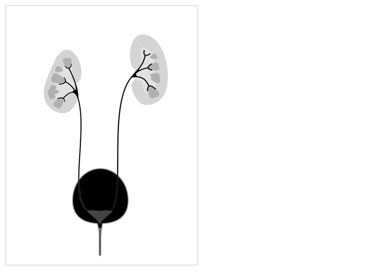 Grades 2 vesico ureteric reflux shown on right of the diagra