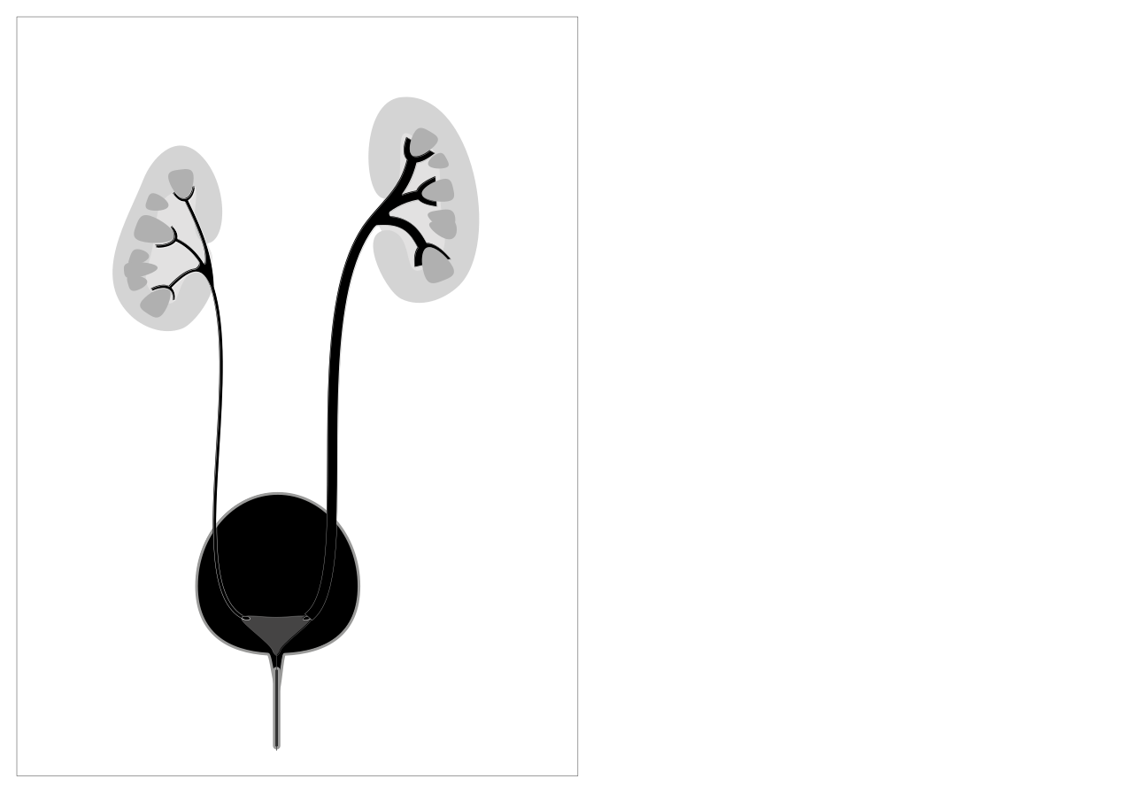 Grades 3 vesico ureteric reflux shown on right of the diagra