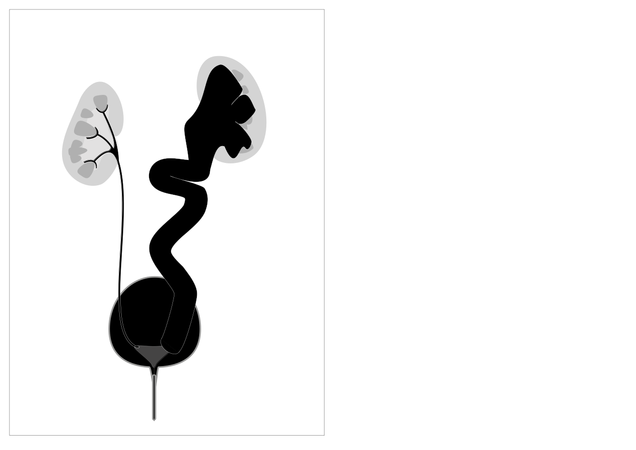 Grades 5 vesico ureteric reflux shown on right of the diagra